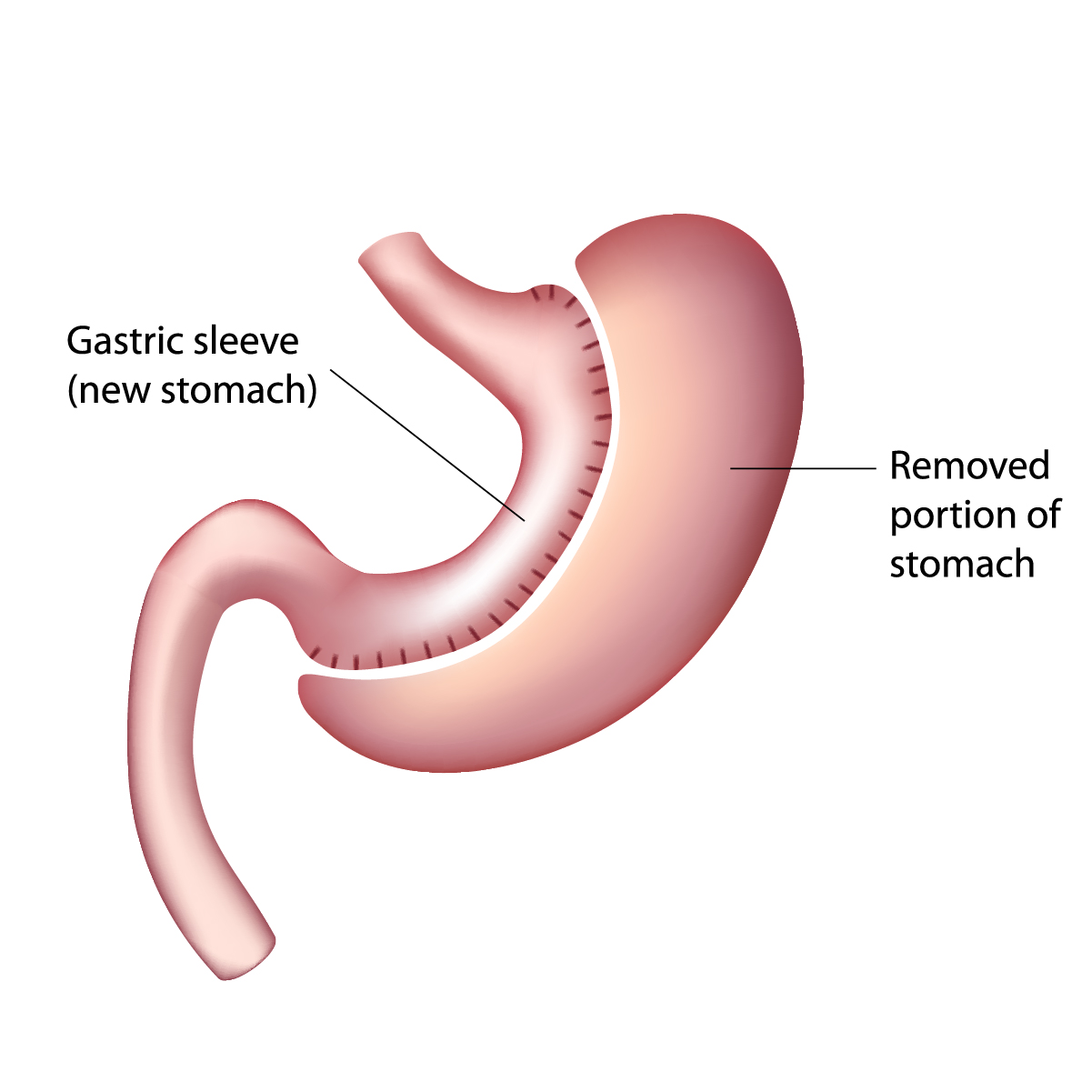 Gastric Sleeve Surgery