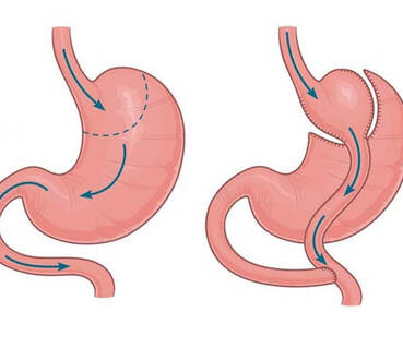 Gastric Bypass Surgery