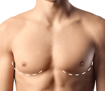 Gynecomastia